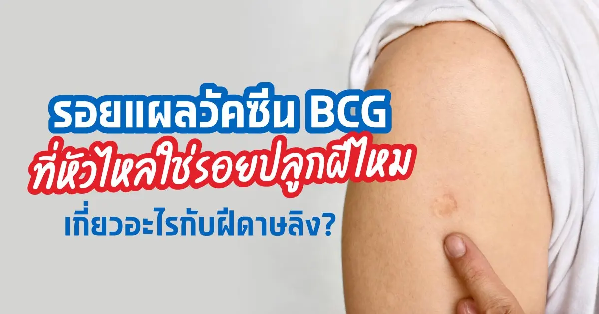 วัคซีน BCG ที่ฉีดทารกแรกเกิดคืออะไร ใช่รอยปลูกฝีหรือเปล่า​?
